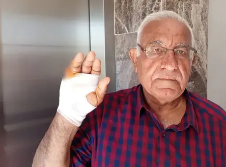 Asansörde korkunç saldırı! Komşusu parmağını ısırarak kopardı: Onu çok severdim, niçin yaptı anlamadım